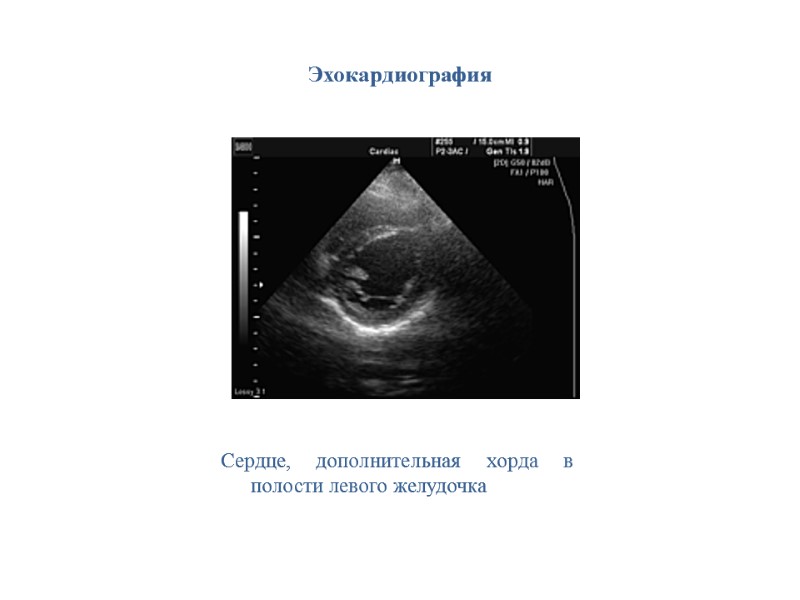 Эхокардиография Сердце, дополнительная хорда в полости левого желудочка